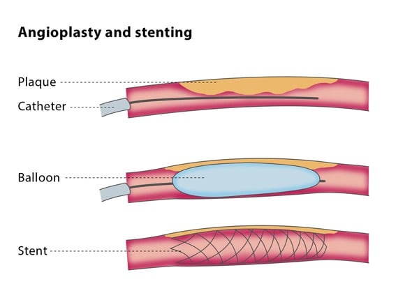 Angioplasty & Stenting