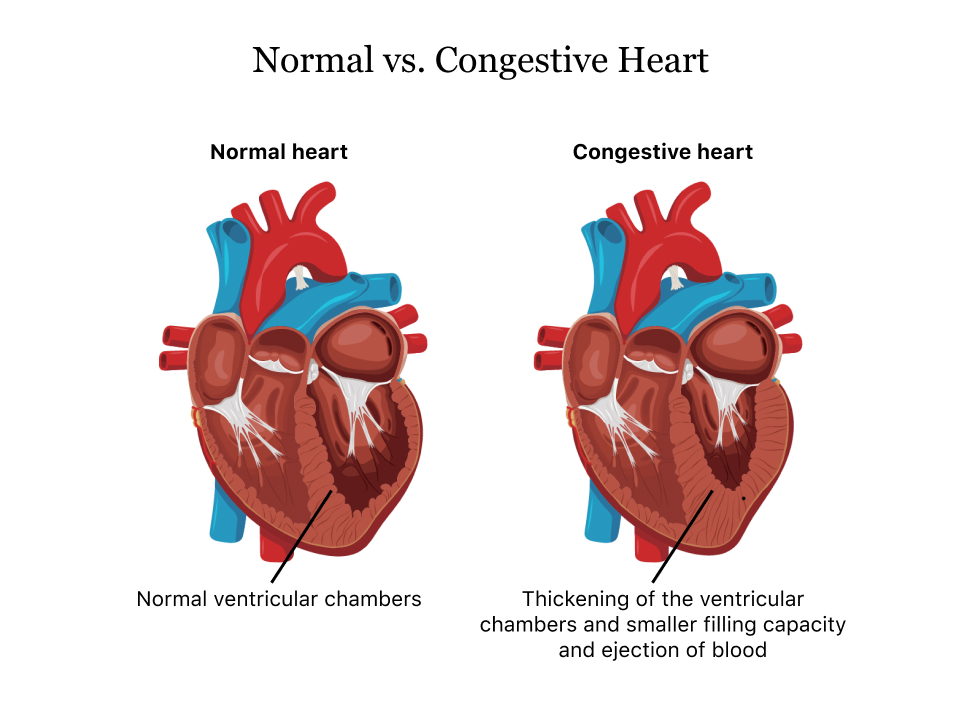 Heart Failure Management