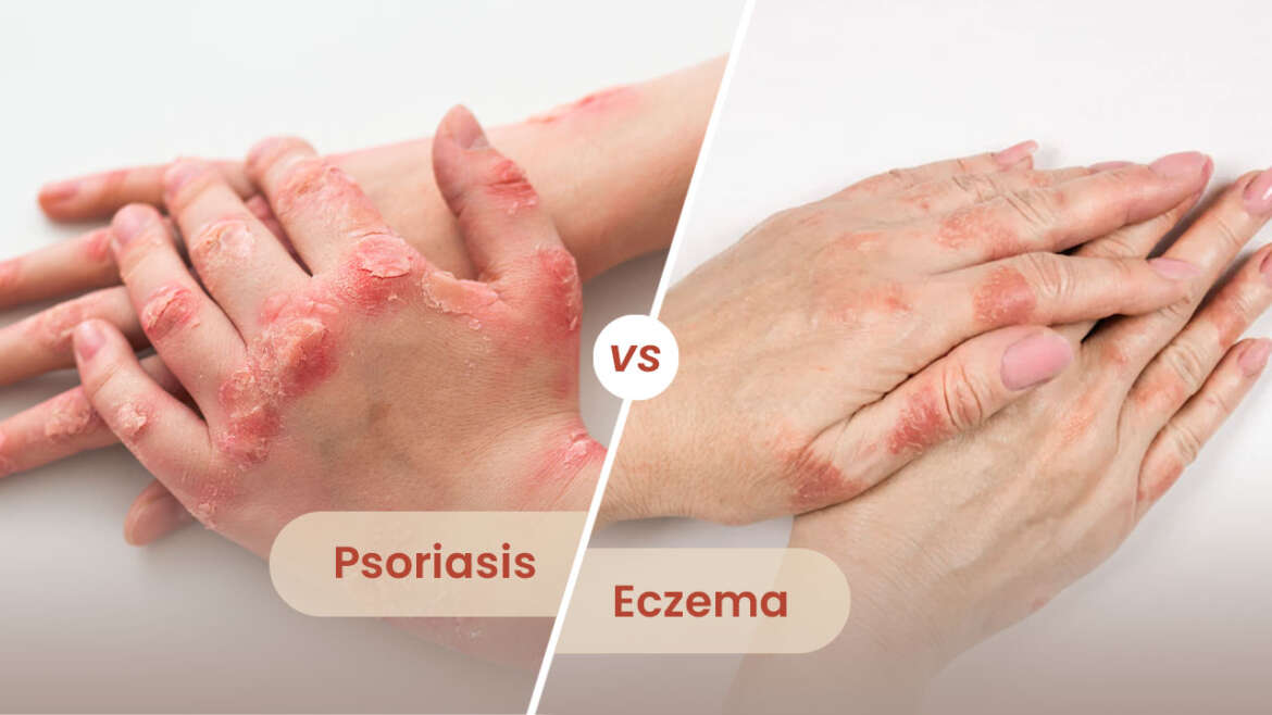 Eczema & Psoriasis Management