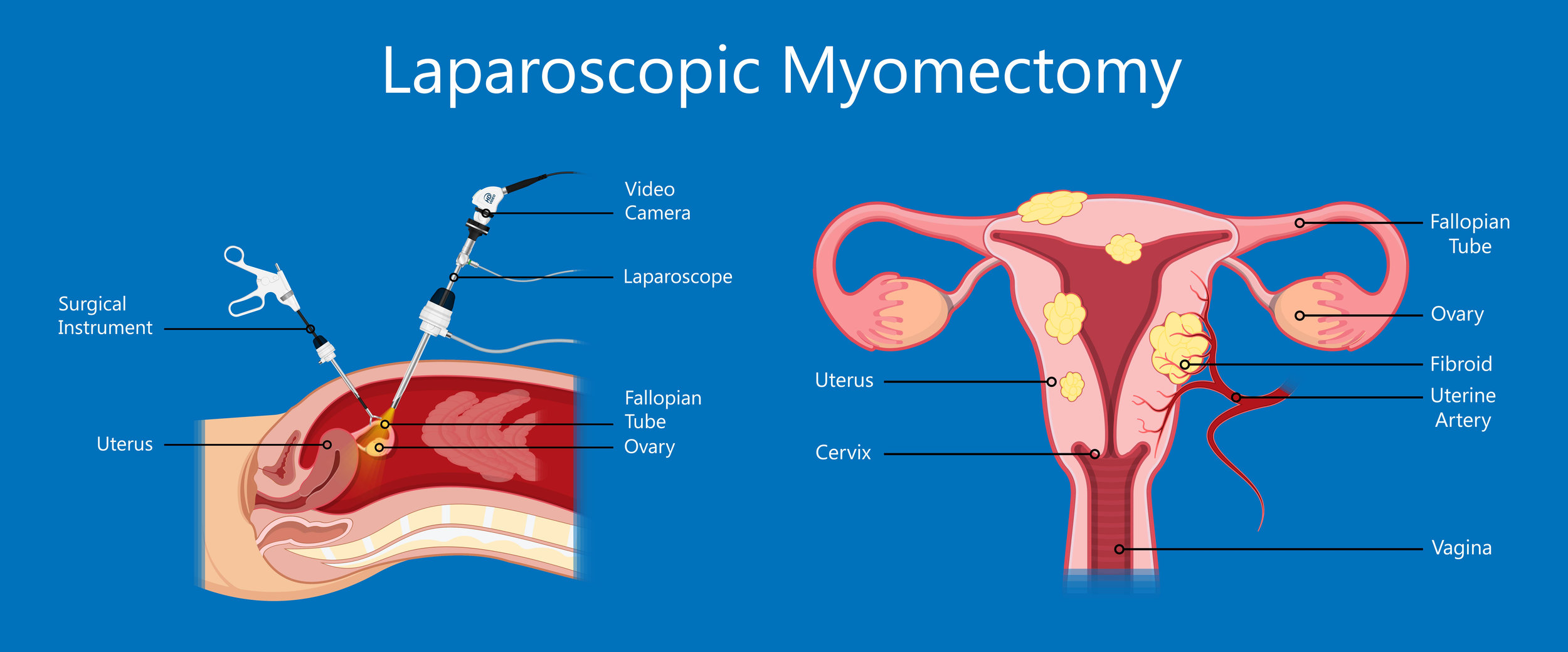 Myomectomy (Fibroid Removal)