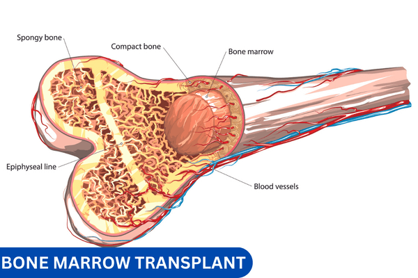 Bone Marrow Transplant