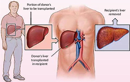 Liver Transplantation