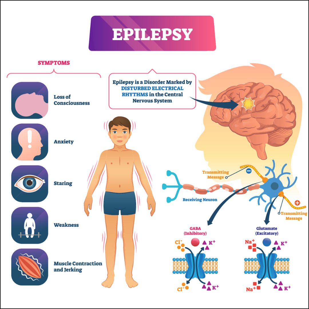 Epilepsy Management