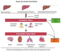 Acute and Chronic Liver Failure Management