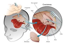 Craniotomy for Traumatic Brain Injury