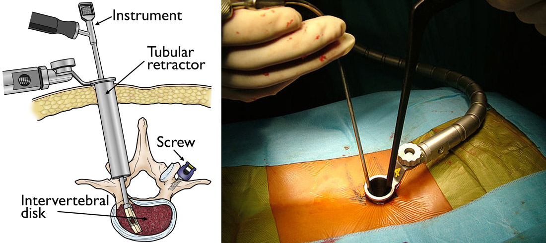 Minimally Invasive Spinal Surgery