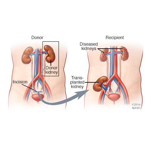Kidney Transplantation