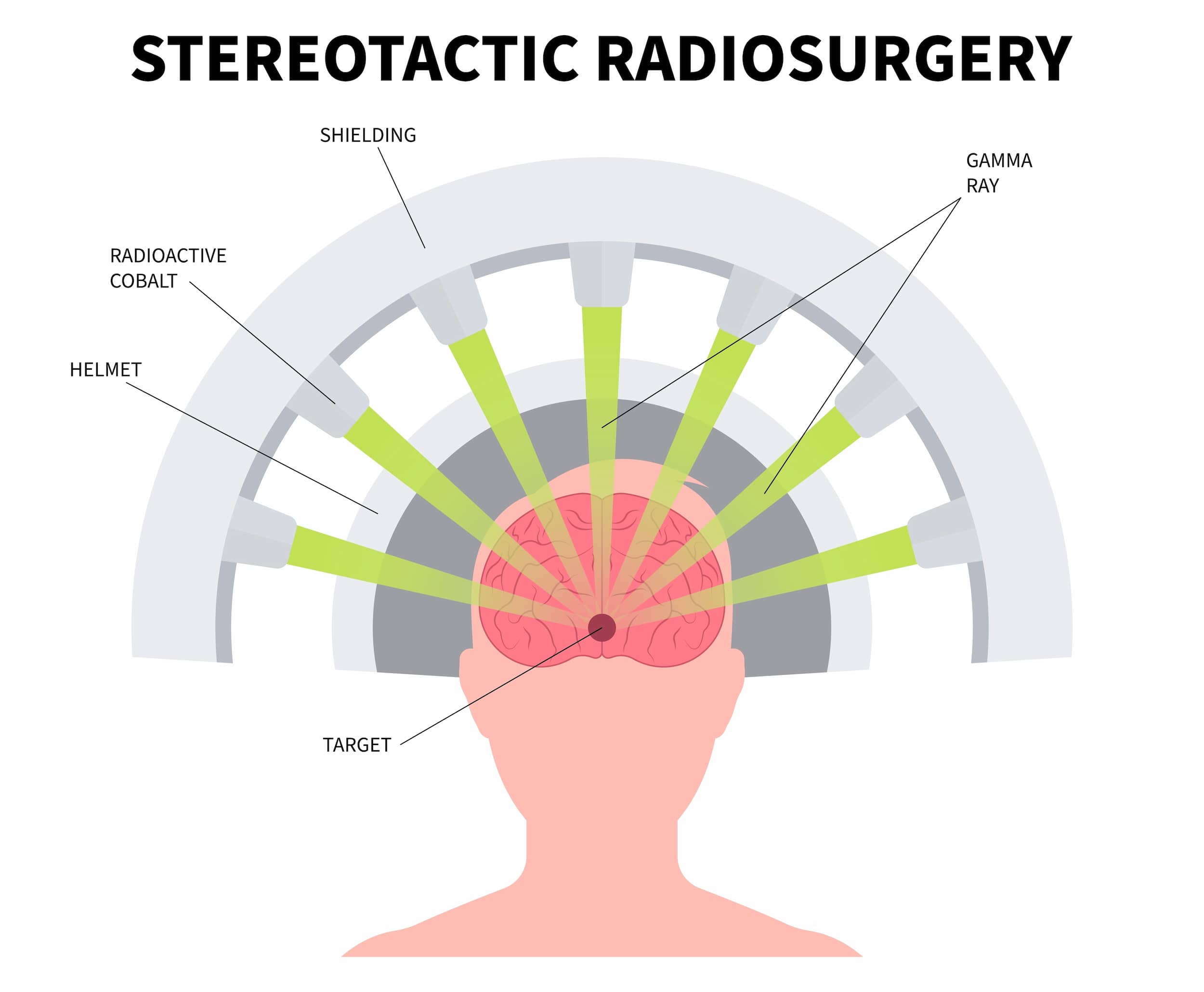 Stereotactic Radiosurgery