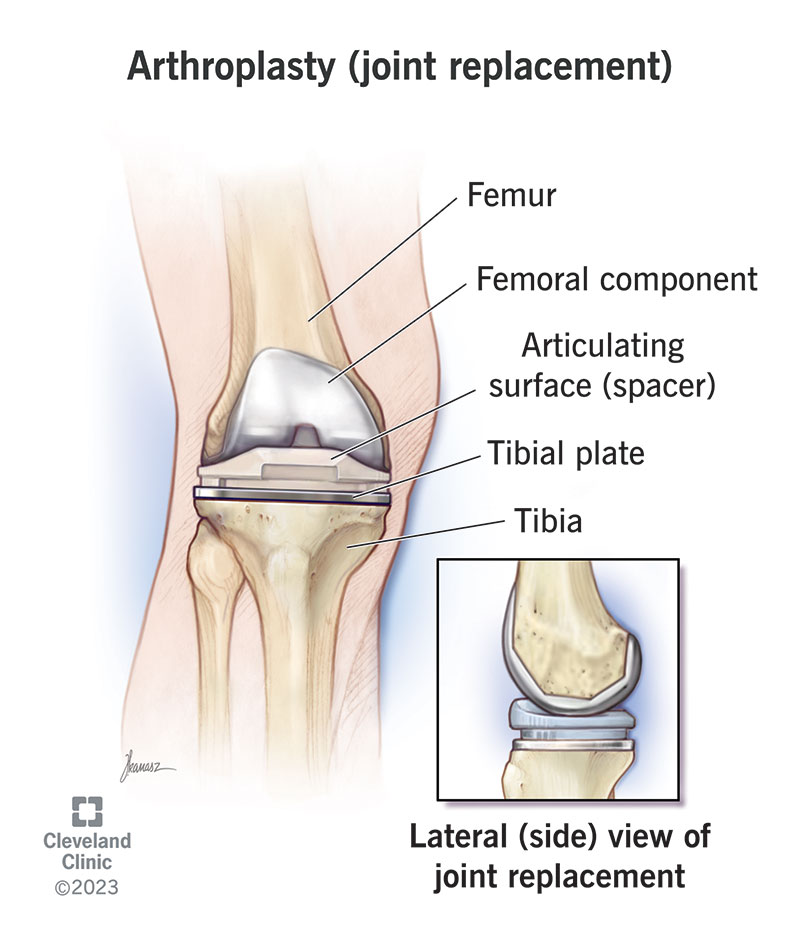 Joint Replacement (Knee, Hip, Shoulder)