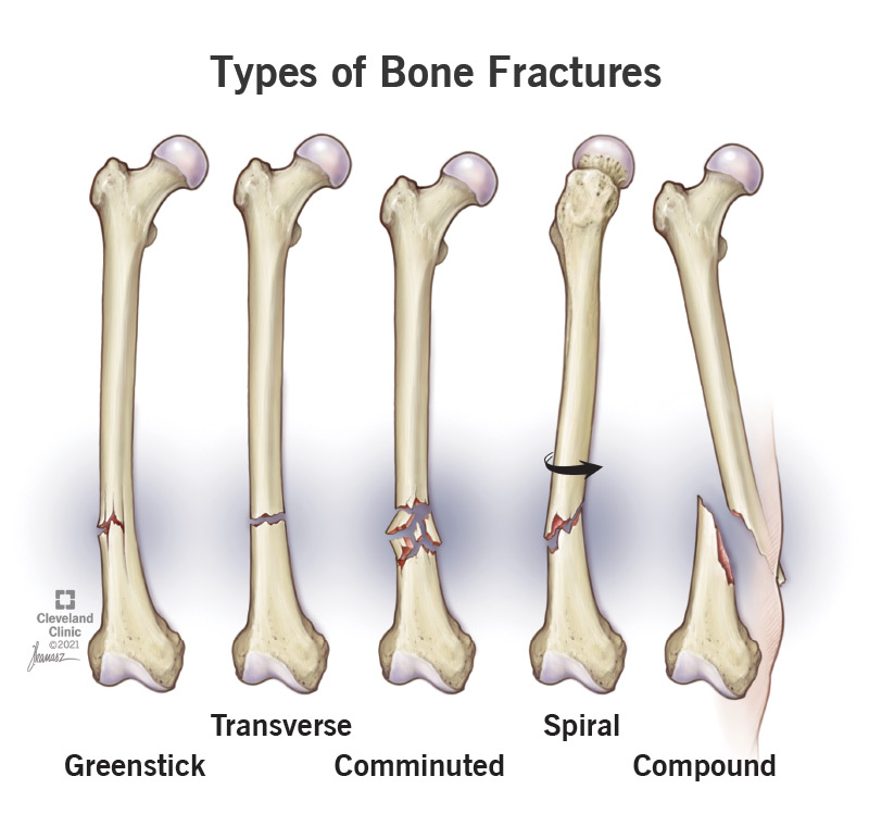 Complex Fracture Management