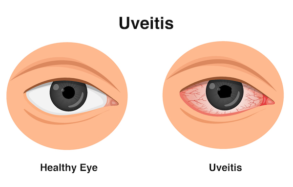 Retina and Uveitis
