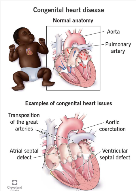 Congenital heart defect repair
