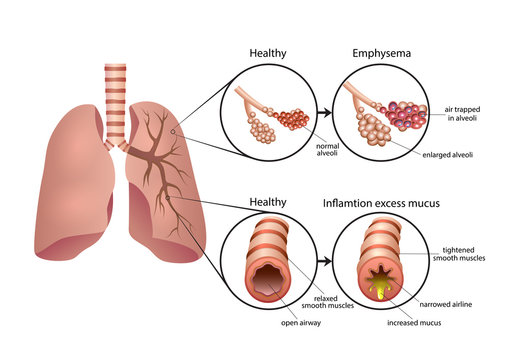 Asthma & COPD Management