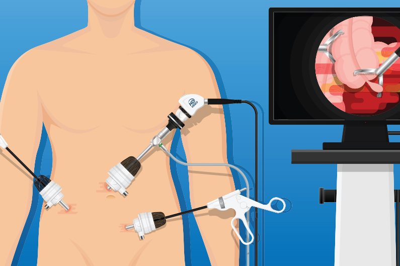 Laparoscopic Surgery 