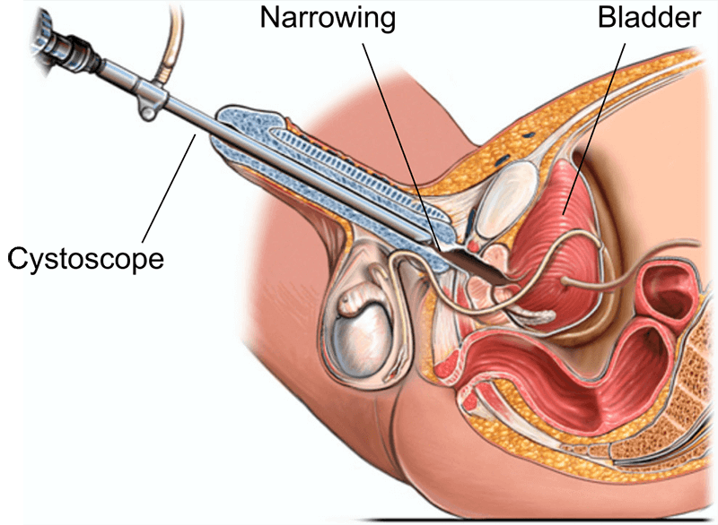 Urological Reconstructive Surgery