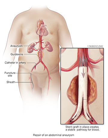 Aortic Surgery