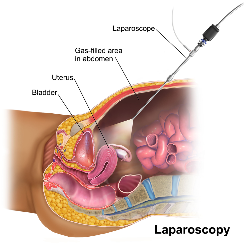 Laproscopy