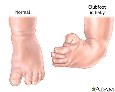 Clubfeet