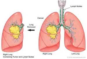 Lung resection (lobectomy, pneumonectomy)