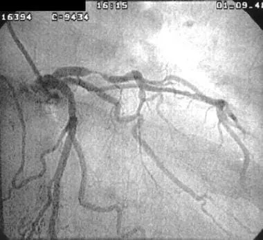 Obstructive shock